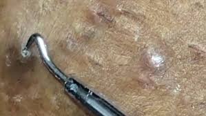 Ingrown pubic hair are hairs that instead of rising up from the skin, they curdle around and grow back into the skin. Pus Streams Out Of Woman S Bikini Line As Ingrown Hairs Are Pulled Out Metro News