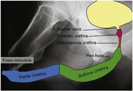 Image result for Urethral Stricture