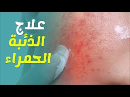 هل مرض الذئبة الحمراء معدي ومميت وماهي طرق علاجه منزليا Youtube