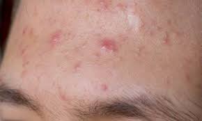 Caratterizzata da papule e pustole simili all'acne giovanile, la rosacea è una patologia dermatologica che è bene trattare fin dagli esordi. Acne Rosacea Cause Sintomi Terapia E Rimedi Medicinalive
