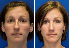 Bulbous Nose Tip Before And After Rhinoplasty Nose Surgery Rhinoplasty Nose Jobs Bulbous Nose