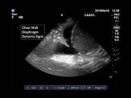 Thoracocentesis of loculated pleural effusions using grey scale ultrasonic guidance. Lung And Pleural Ultrasound Interpretation Youtube