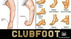 Most children born with club foot are treated successfully, but those born with only one foot affected may be left with a slightly shorter leg or smaller foot. Clubfoot Its Types And Causes Simplified In Hindi Youtube