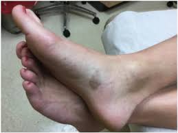 There are a number of bacteria that can cause necrotizing fasciitis. The Color Of Skin Black Diseases Of The Skin Nails And Mucosa Sciencedirect
