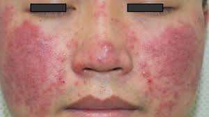 Image result for mite bites on humans