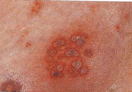 Gürtelrose symptome, ursachen & krankheitsverlauf. Windpocken Und Herpes Zoster Gurtelrose Und Naturheilkunde Naturmedizin Leben