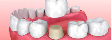 | yes, the terms caps, dental caps and tooth caps are all interchangeable and can be used to refer to any type of dental crown. The Pros And Cons Of Dental Crowns Precision Dentistry
