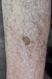 Image result for liver spots on legs
