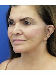 Cases in Facelift Deep Plane