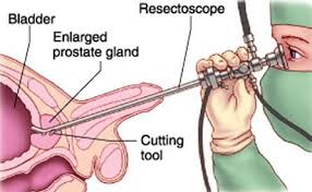Transurethral Resection Of The Prostate Turp Benign Prostatic Hyperplasia Prostate Prostate Health
