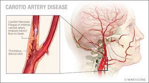 It arises from the common carotid artery when it splits into the external and internal carotid artery. Carotid Disease Treatment Carotid Artery Blockage Surgery