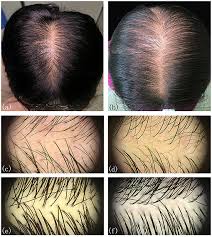 The hairline typically pulls backward from the in terms of the receding hairline, stage 3 vertex balding is a less drastic version of stage 3. Frontiers Female Pattern Hair Loss In Female And Male A Quantitative Trichoscopic Analysis In Chinese Han Patients Medicine