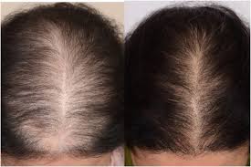Hair loss is a common clinical complaint that is a manifestation of a wide variety of disorders. Platelet Rich Plasma For Androgenetic Alopecia A Review Of The Literature And Proposed Treatment Protocol Sciencedirect