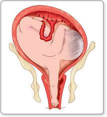 Image result for Shoulder Presentation