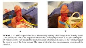 Image result for Chordee