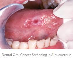 It is after plating of the tissue, which is extracted from that particular lumpy layer, the doctors get to know whether it is a cancerous growth or just an. Oral Cancer Screenings New Age Dentistry Dental Oral Cancer Screening In Albuquerque Oral Surgeon Albuquerque