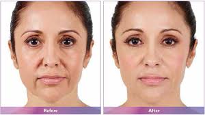 Fillers and Plumpers