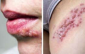 Image result for genital herpes