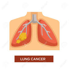 Chronic, hacking, raspy coughing, sometimes with mucus that has blood in it. Oncology Or Lung Cancer And Tumor Disease Or Illness Vector Human Chest With Malignant Or Benign Tumor Smoking Danger And Chemotherapy Or Treatment Carcinoma Sickness And Therapy Health Damage Royalty Free Cliparts