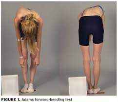 The best way to check for scoliosis is have the person wear their underwear or swim wear. Scoliosis Symptoms Spotting The Most Common Signs