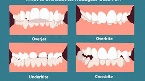 Do i eat with them because he didnt tell me ? Orthodontic Headgear Purpose Uses And What To Expect