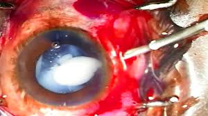 Manual Small Incision Cataract Surgery Msics Morgagnian Nugget Youtube