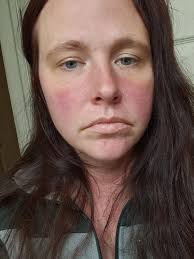 Has anyone tested positive ANA then negative?