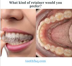 I have a gap and my front left tooth is crooked. What Kind Of Retainer Would You Prefer After Braces A Fixed Wire Or A Removable That You Have To Wear Every Night Dentist Humor Dentist Invisalign