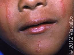 Image result for dermatitis contacta children