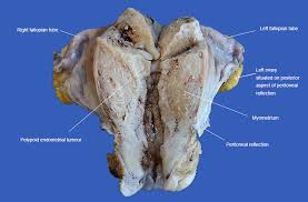 In brief, endometriosis is a disease where the cells that line the uterine wall grow outside of the uterus and attach themselves to anything they can find. Rcpa Uterus Endometrial And Myometrial Malignancies
