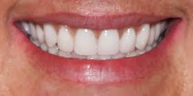 The denture is customized for your smile so it is natural looking and suits your needs. Gallery Full Dentures Dentist In Rockwall Tx Fisher Zitterich Dentistry