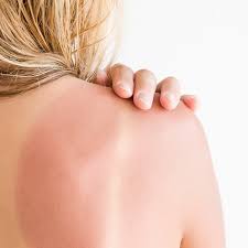 Image result for Sunburn