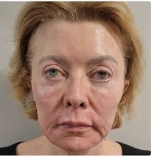 Recently had Neogen Plasma Treatment