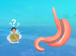 Gibt Es Irgendwelche Risiken Einer Schlauchmagen Operation Dr He Obesity Clinic