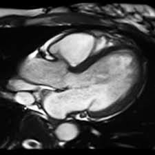 Image result for Cardiac MRI