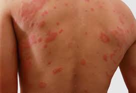 Image result for Papular urticaria