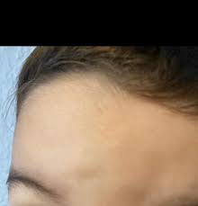 Die wunde ist relativ klein und bis jetzt gehts ihr gut. Kleinkind 2 Jahre Leichte Beule N Am Kopf Krankheit Kinder Schwellung