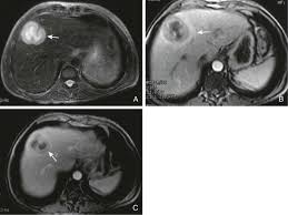 Image result for Liver Abscess