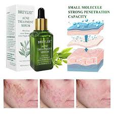 Rich Tea Pholyphenols To Heal Acne Facialserum Acne Treatment Severe Acne Skin Serum