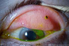 Image result for Eye Foreign Body