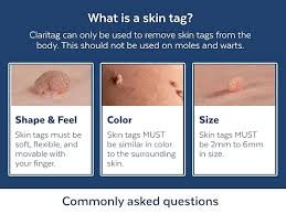 Image result for Skin Tag