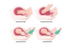 Image result for Forceps Assisted Delivery