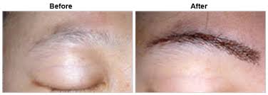 Certain autoimmune diseases that can result in eyebrow hair loss include alopecia areata, alopecia frontal fibrosing, and lupus erythematosus discoid. Eyebrow Hair Loss Treatment Eyebrow Hair Robin Herbals