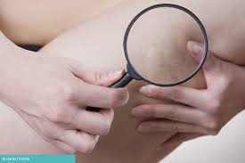 Seltener ist eine thrombose im arm oder im becken. Thrombose Symptome Ursachen Und Behandlung Docsonnet