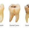 How to remove a tooth at home. 1