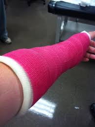 Image result for Short Arm Cast