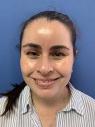 Precio del tratamiento con botox y otras preguntas frecuentes. Aplicacion De Botox Y Acido Hialuronico En Pereira Colombia