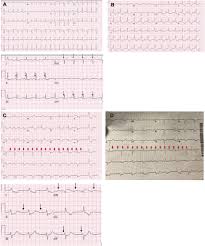 The ecg is used to diagnose acute pericarditis. Rhythm Conduction And St Elevation With Covid 19 Myocarditis Or Myocardial Infarction Heartrhythm Case Reports