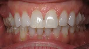 I'm hypoglycemic and the continual eating of specific foods throughout the day keeps me feeling great and sharp at work. Invisalign Attachments Why Are They Needed Cater Galante Orthodontics