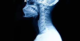 What Is C1 C2 Dislocation Its Symptoms And Treatment Methods Vikram Hospital Blog